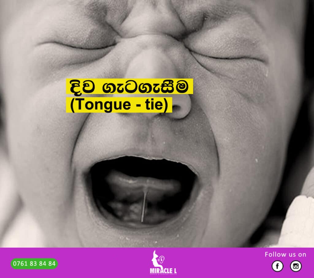 Tongue tie child open his mouth and cry